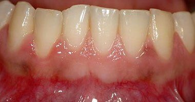  مكافحة التسوس والتهابات اللثة يقي الفم من الأمراض