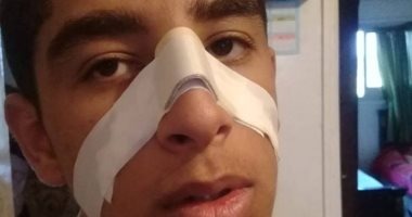  طالب يكسر أنف زميله داخل مدرسة سعود الثانوية بالحسينية