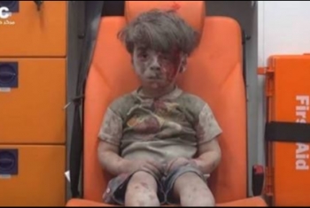  وفاة شقيق طفل حلب الذي صدمت صوره العالم متأثرًا بجراحه