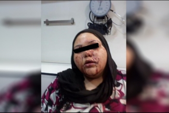  إصابة سيدة بخرطوش في عينيها بسبب الميراث في بلبيس